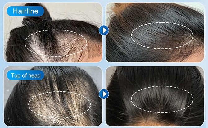 Kopexil powder Kopexil powder