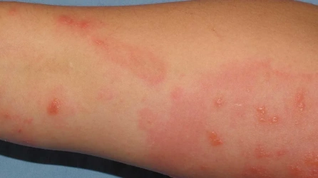 Itching